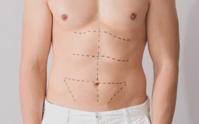 Abdominoplastia: cuándo es el momento ideal para hacerla