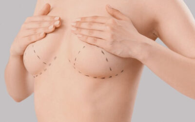 Mastopexia: cómo levantar y remodelar el busto de forma natural