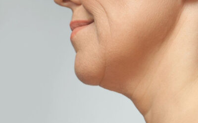 Bioestimulación con Sculptra