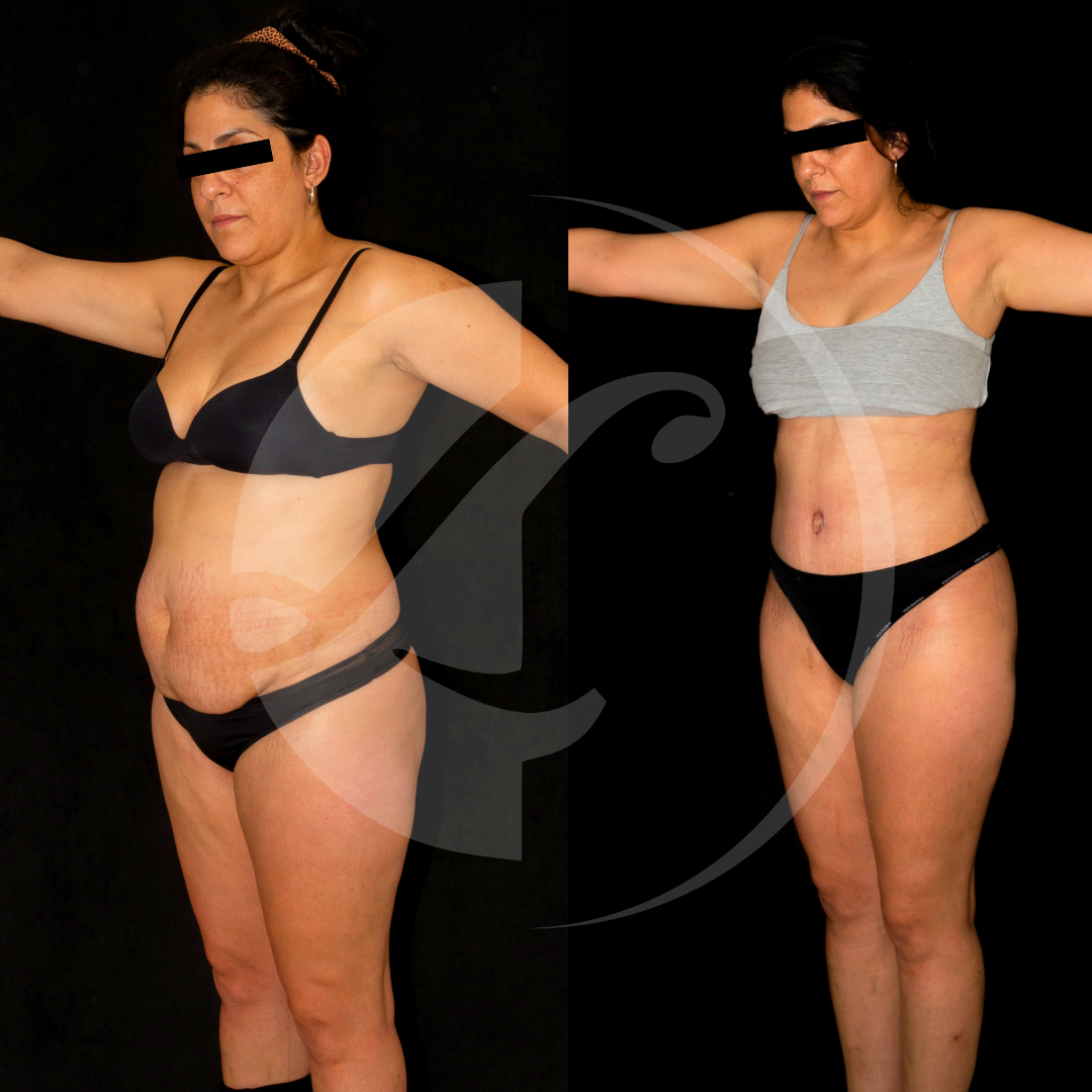 Pacientes antes y despues de una abbdominoplastia