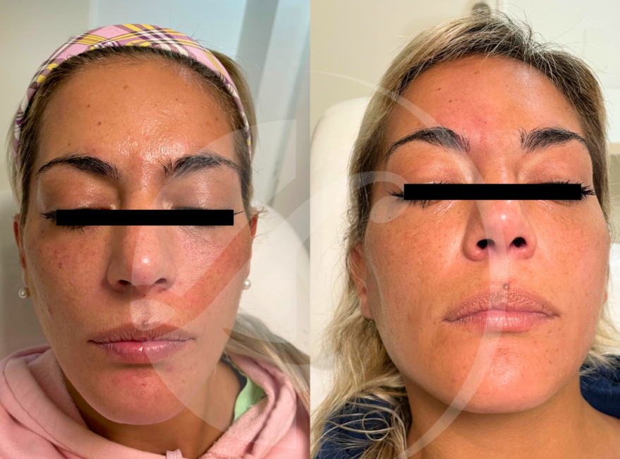Paciente antes y despues de una armonizacion facial
