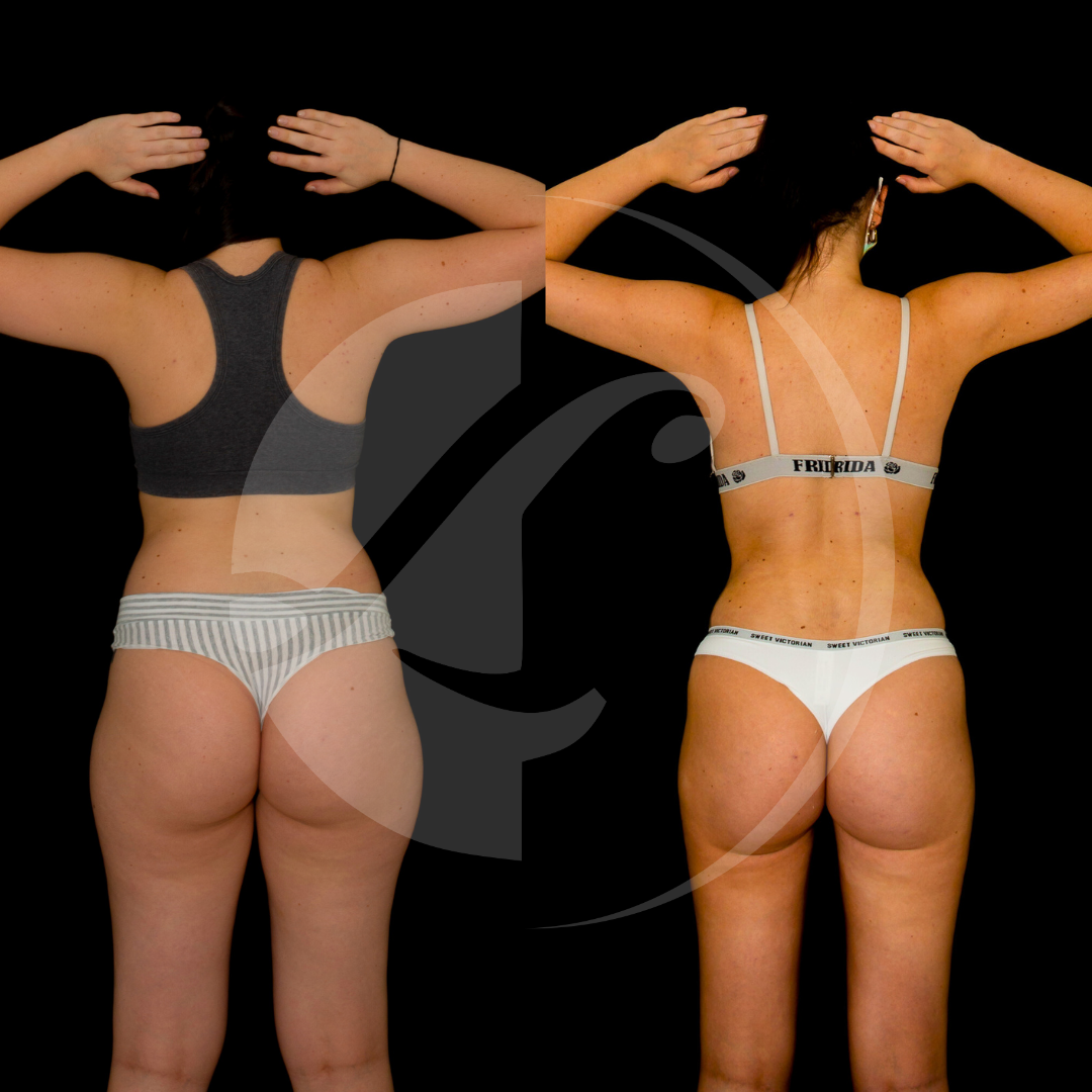 Paciente antes y despues de un Lifting de Brazos y Muslos