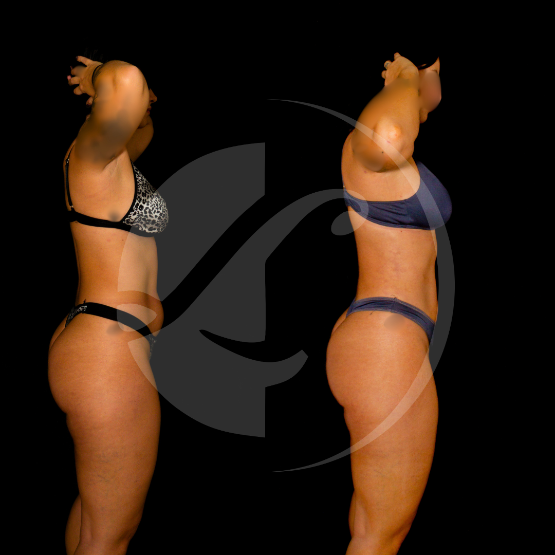 Paciente antes y despues de una lipoescultura