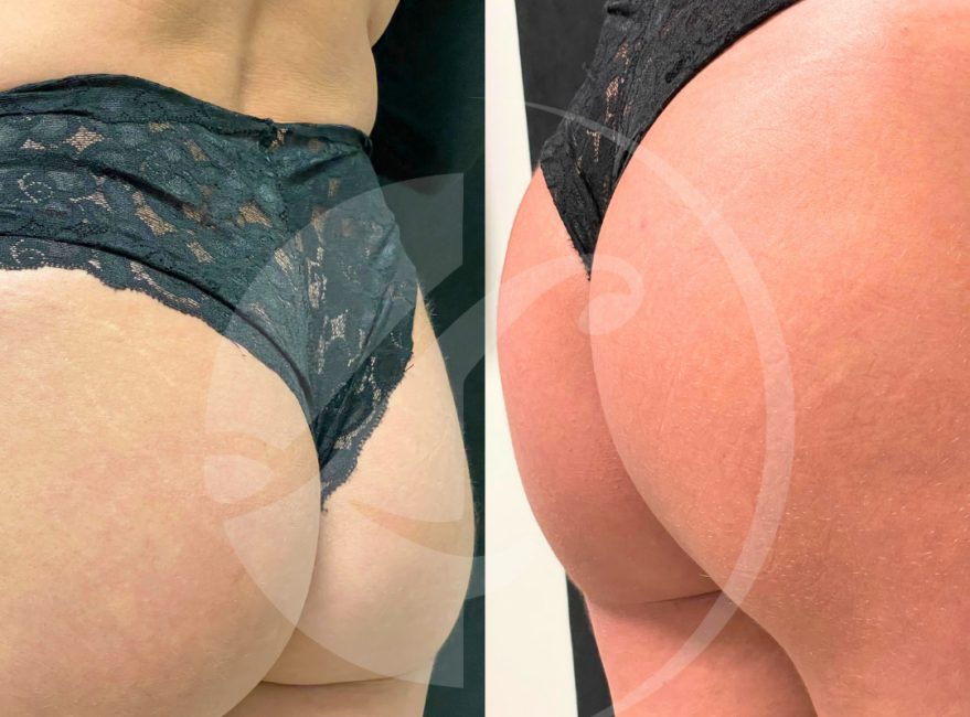 Paciente antes y despues de Ecilis en gluteos