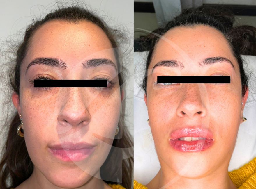 Paciente antes y despues de embellecimiento labial con hialuronico